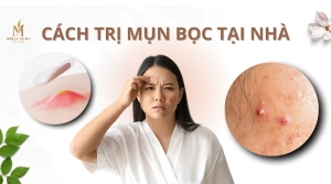 Cách trị mụn bọc tại nhà an toàn, hiệu quả tốt nhất