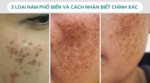 3 Loại Nám Phổ Biến Và Cách Nhận Biết Chính Xác Từ Mire Home Spa