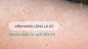 Viêm nang lông là gì? Nguyên nhân và cách điều trị