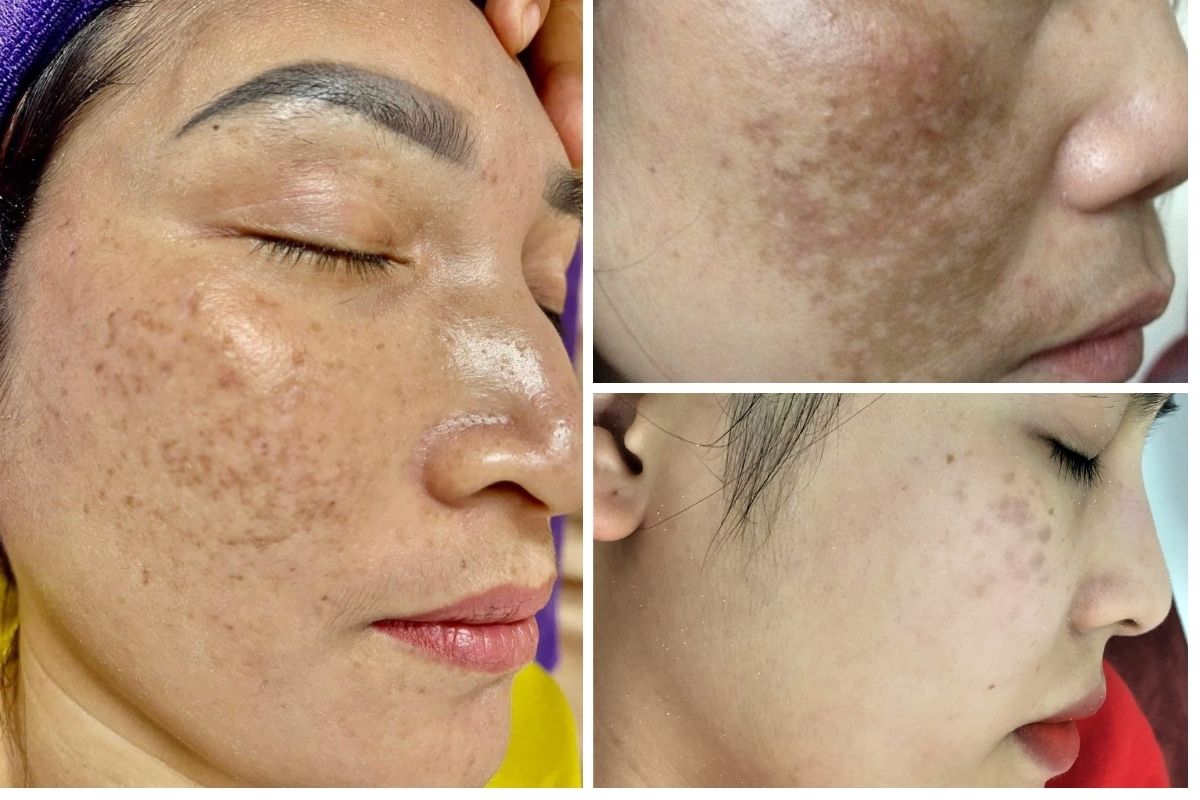 Bắn laser trị nám có hiệu quả không?