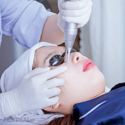 Trị nám bằng laser là gì?