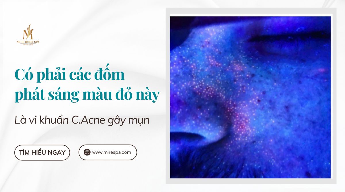 Ứng dụng công nghệ AI phát hiện vi khuẩn gây mụn trứng cá