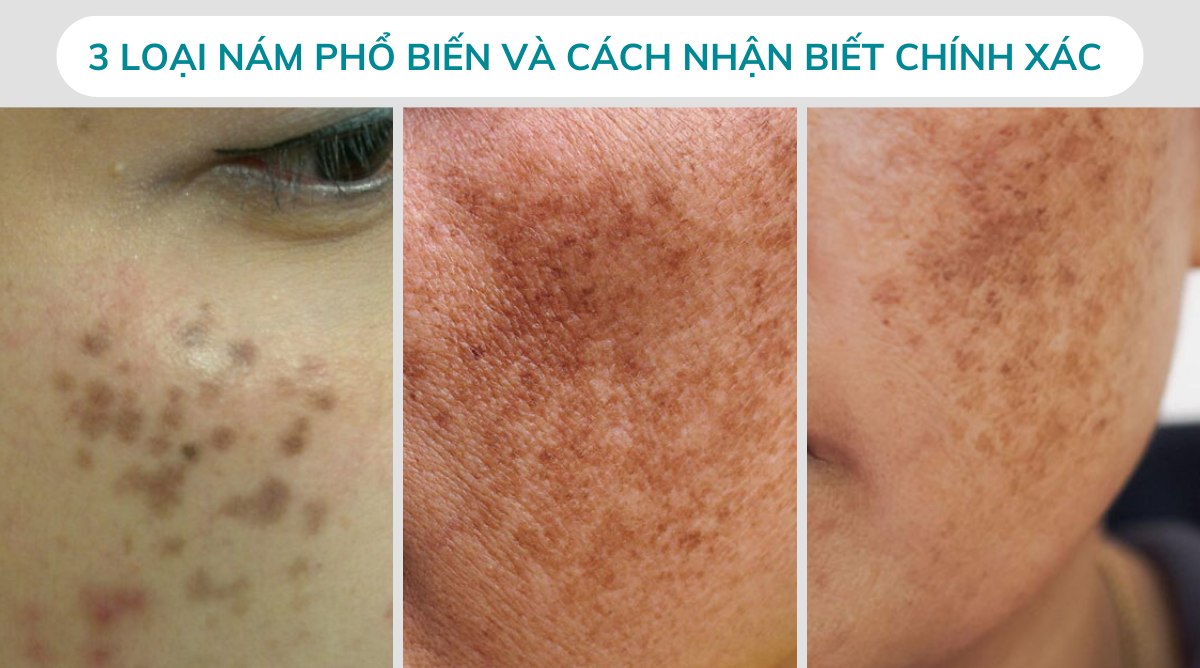 3 Loại Nám Phổ Biến Và Cách Nhận Biết Chính Xác