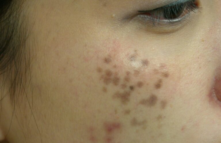 Nám chân sâu – Cứng đầu và khó trị nhất