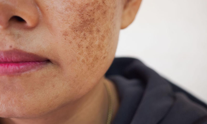 Nám hỗn hợp – Sự kết hợp giữa nám mảng và nám chân sâu