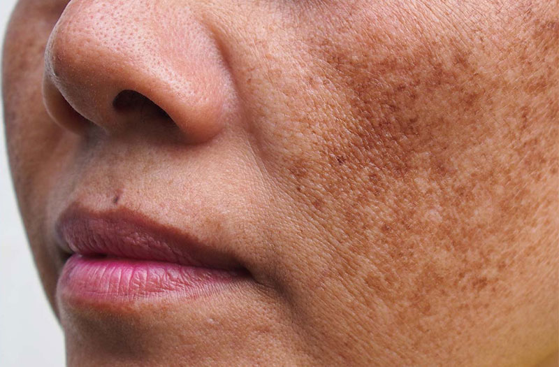 Nám mảng – Dễ nhận biết, dễ cải thiện