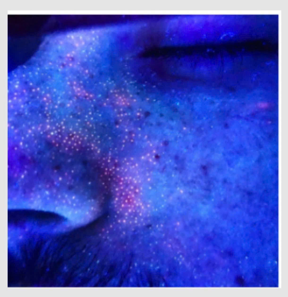 AI 'Nhìn Thấu' Làn Da: Phát Hiện Porphyrin Qua Ảnh Chụp Thông Thường