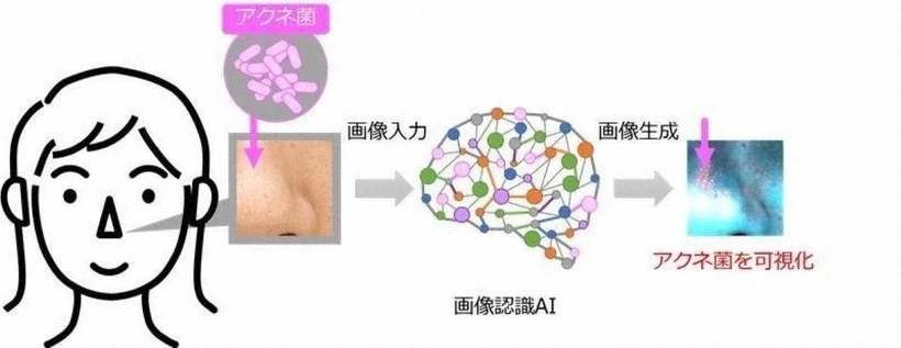 Hình ảnh do Lion Corp. cung cấp cho thấy công nghệ giúp hình dung vi khuẩn Cutibacteria Acnes chịu trách nhiệm gây ra mụn trứng cá.