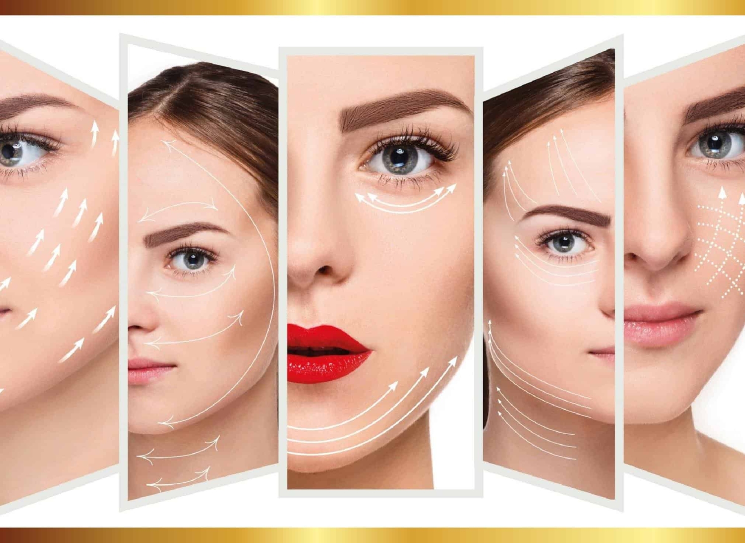 Hiệu quả thẩm mỹ khi sử dụng Hifu